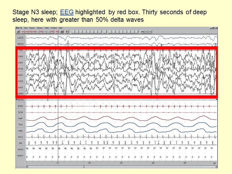 Stage N3 sleep; EEG highlighted by red box. Thirty seconds of deep sleep, here